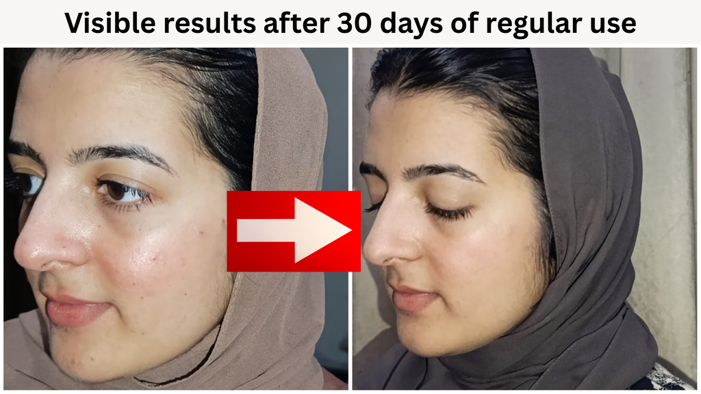 Moles And Skin Tag Remover Cream